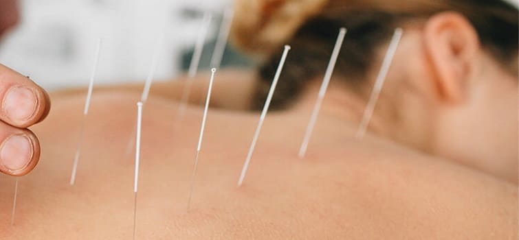 Acupuncture