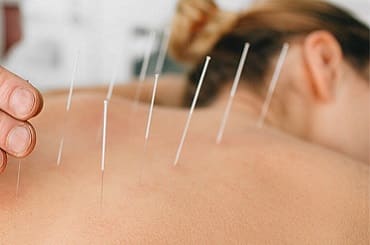 Acupuncture Services in Bhayander