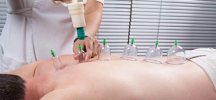 Cupping Therapy